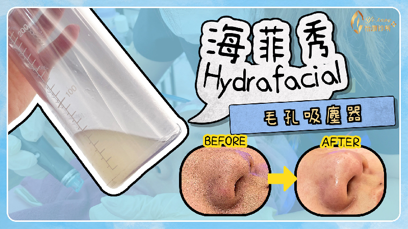 海菲秀HydraFacial(水飛梭)，毛孔吸塵器，粉刺的剋星