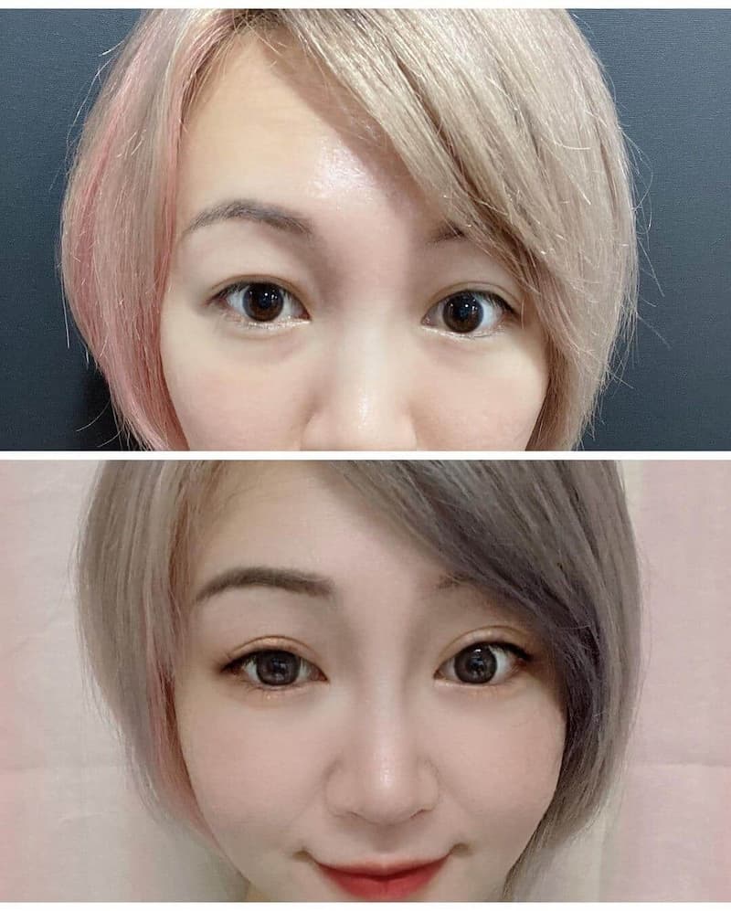 女神玻尿酸淚溝